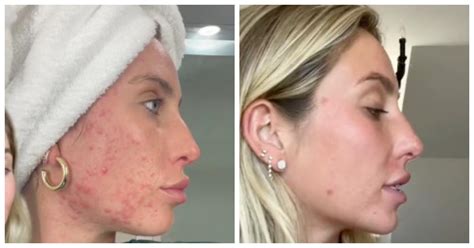 alix earle before accutane|Alix Earle Shares Jaw